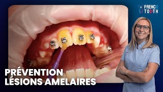 Prévention lésions amelaires en Orthodontie avec vernis fluoré Duraphat  Dr Médio [upl. by Justin]