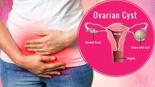 Ovarian cyst causes treatment  নারীদের ওভারি সিস্ট কি কেন হয় এবং করণীয় [upl. by Harvison918]