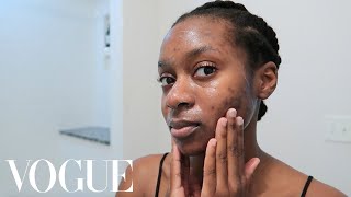 Morning Skin Care Regimen for Acne Hyperpigmentation and Acne Scars [upl. by Notneiuq625]