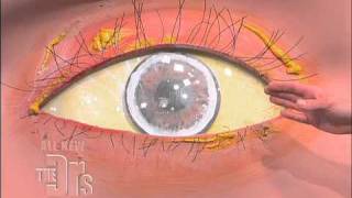 Cholesterol Deposits in the Eye The Doctors [upl. by Salohci145]