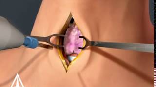 Tracheotomy  3D animation [upl. by Akemyt]