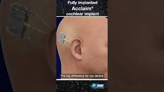 How Does it Work Cochlear Implant Fully Under Skin Undergoing Clinical Trial at Mayo Clinic [upl. by Issak]