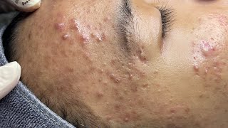 ACNE TREATMENT VU QUYNH MI  Perennial Blackheads On Boy Face 2024FULL [upl. by Mello145]