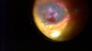 Choroidal Melanoma  Uveal Melanoma [upl. by Penrose]