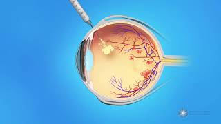 Eye Injections for Central Retinal Vein Occlusion CRVO [upl. by Idaf]