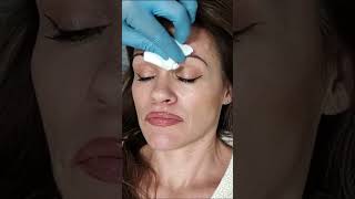 APLICACIÓN de HILOS Tensores ESPICULADOS y BOTOX en Vivo ¡Os MUESTRO el Proceso y los Resultados 💉 [upl. by Noied]