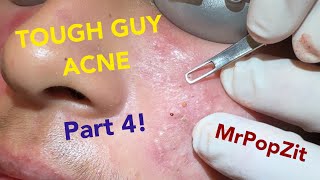 Tough Guy Acne part 4Acne extractionsMake an appointment with me details in description Lets go [upl. by Egin]