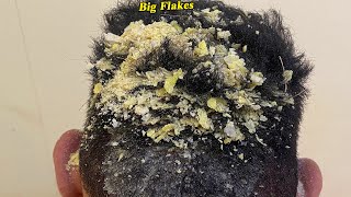 DRY SCALP  Big Flakes Dandruff Scratching Satisfying Video 807 [upl. by Yttisahc]