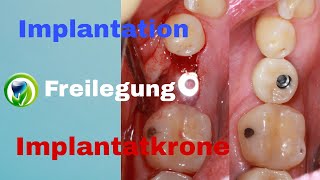 Zahnimplantation Freilegung Abformung Implantatkrone  Ablauf  Zeitraum  Dauer  Termine [upl. by Shermy100]