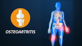 Medicina para todos Dolores articulares osteoartritis [upl. by Nabi]