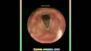 Stroboscopy  Normal mucosal wave of vocal fold [upl. by Demakis]