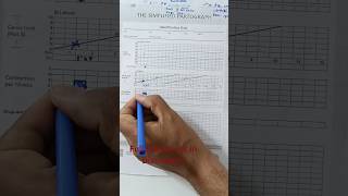 How to fill a partograph in labour  partograph in hindi shorts shortsfeed [upl. by Melantha831]