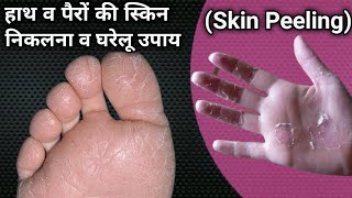 Skin peeling kya hai  Hatho ki skin hatna  Hatho ki skin utarna  pairo ki skin nikalna [upl. by Orvas52]