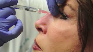 Nonsurgical Rhinoplasty [upl. by Darsey]