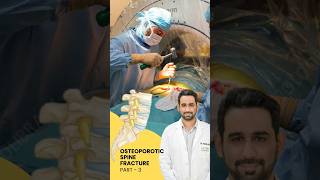 Treatment of Osteoporotic spine fracture  Dr Dheeraj Batheja  Artemis Hospital doctor spine [upl. by Cowen]