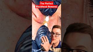 🥇 The Perfect BLACKHEAD REMOVAL 2024 shorts [upl. by Llessur742]