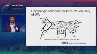 Endovascular Management Of Pulmonary Embolism Including Catheter Directed Lysis And Thrombectomy [upl. by Ledarf]