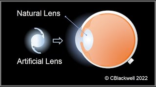 Intraocular Lens Implants 1 Inspiration and Development [upl. by Annaig]