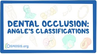 Dental occlusion  Angle’s classifications [upl. by Akirdnuhs]