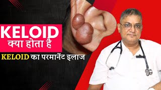 Get Rid Of Keloids Forever Effective Keloid Treatment By Dr Naren Pandey [upl. by Armitage]