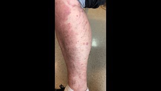 Neuromyotonia Due to Autoimmune Isaacs Syndrome in a Patient With Psoriasis [upl. by Nylinej]