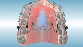 Nitanium® Palatal Expander²™ MultiPurpose Finishing Appliance [upl. by Aianat]