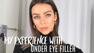 Under Eye Filler Injections  My experience  before and after [upl. by Laure51]