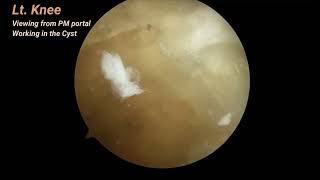 Arthroscopic Decompressive Cystectomy of Baker Cyst of the Knee [upl. by Cirenoj]