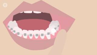 How To Deal With Braces Discomfort  Whats Normal Whats Not amp What To Do [upl. by Graner]