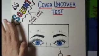 Types of squint and Cover uncover test [upl. by Nagap]