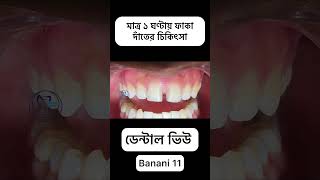 Faka dater chikitsha matro 1 ghontay dental smiledentist toothwhitening [upl. by Conte]