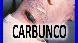 CARBUNCO FURÚNCULOS  ÁNTRAX MALIGNO [upl. by Aynotahs]