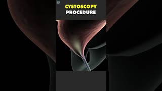 Cystoscopy Procedure Surgical3D 3DSurgery Anatomy3D [upl. by Kcirevam]