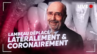 En Direct  🔴 Lambeau déplacé latéralement amp coronairement 🦷 [upl. by Uolyram]