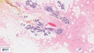 Breast Fibrocystic change microscopy  Talking slide [upl. by Sidnala]