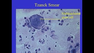 Tzanck smear Positive [upl. by Dranal]