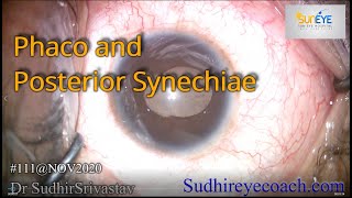 Phaco and Posterior Synechiae  DR SUDHIR SRIVASTAVA [upl. by Adil]