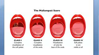 Anesthesia Mallampati score grading MP Airway Evaluation Open mouth Large tongue Intubation PAC [upl. by Aihsrop]