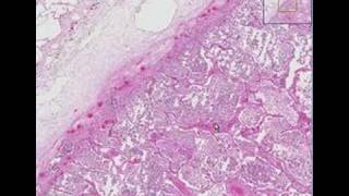 Histopathology Lung Lobar pneumonia [upl. by Dicks]