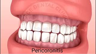 What is Pericoronitis When is Operculectomy Brace Dental Clinics [upl. by Zumwalt281]