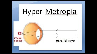 Ophthalmology 044 b HyperMetropia HyperOpia long sightedness Shot silk appearance pseudopapillitis [upl. by Vinni720]