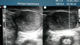 Testicular Microlithiasis Ultrasound [upl. by Darcy]