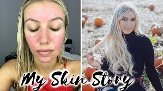 HOW I CURED MY ACNE ROSACEA BEFORE amp AFTER MY SKIN STORY REDNESS ACNE TREATMENT Scarlett London [upl. by Sharline]