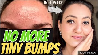 1 WEEK CHALLENGE 💕 GET RID OF TINY BUMPS NATURALLY in just 7 Days and Get Amazing EVEN SKINTONE [upl. by Silenay]