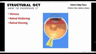 INTERPRETACION TOMOGRAFICA ESTRUCTURAL DE LA MACULA [upl. by Resor]