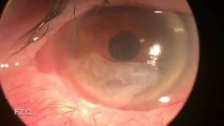 Queratinización corneal y simbléfaron [upl. by Fine459]