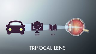 What Are My Lens Options for Cataract Surgery [upl. by Trammel]