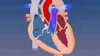 Atrial Septal Defect [upl. by Ania270]