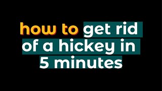 TIPS how to get rid of a hickey in 5 minutes [upl. by Aleemaj638]