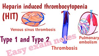 Heparin induced ThrombocytopeniaHIT in hindi and urdu [upl. by Adai946]